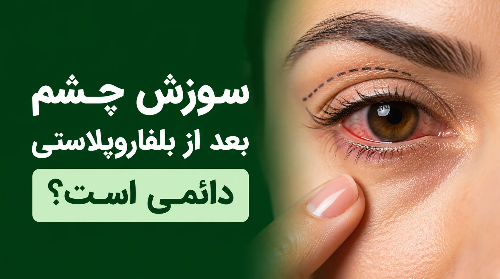 سوزش چشم بعد از بلفاروپلاستی دائمی است؟
